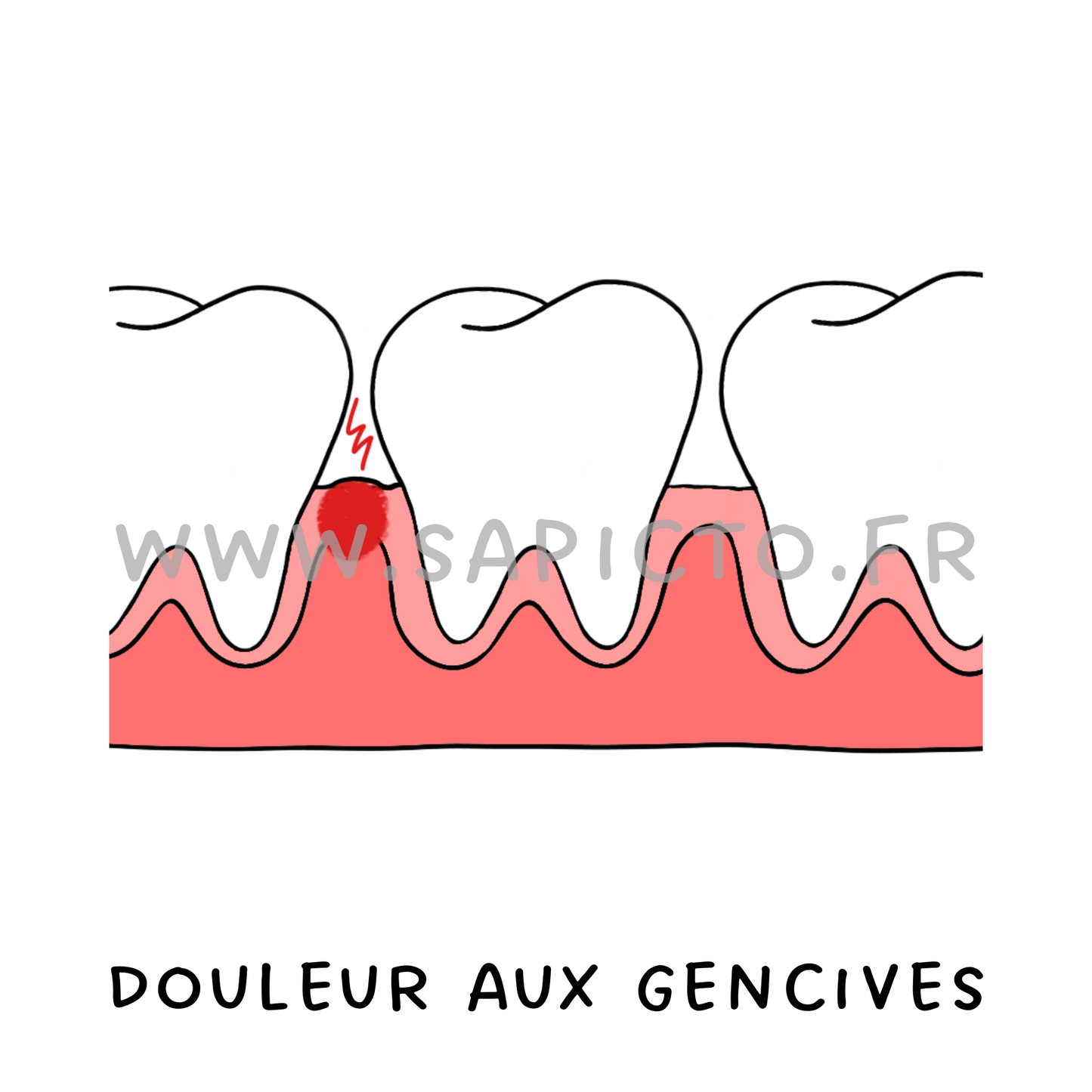 Douleurs aux gencives