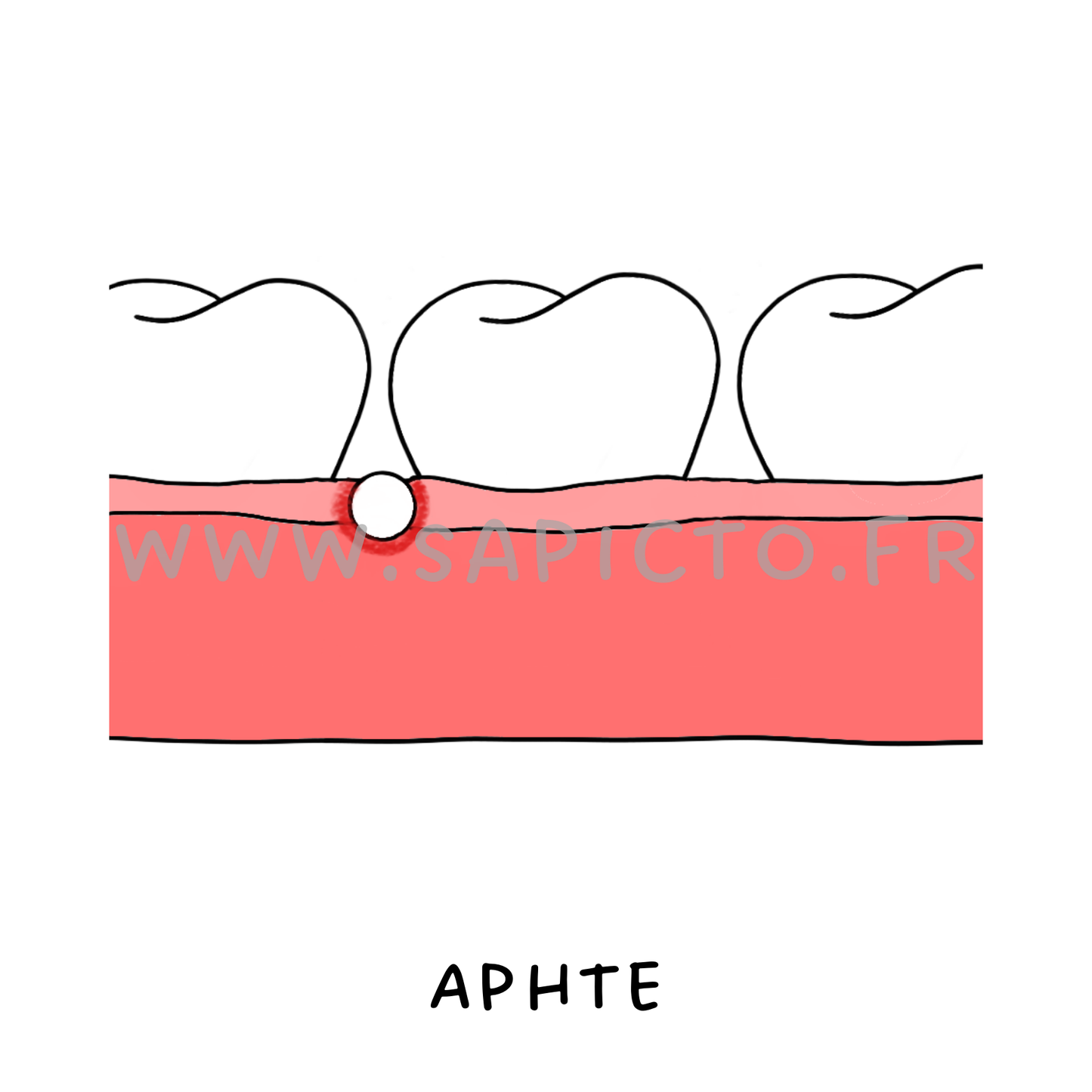 Aphte