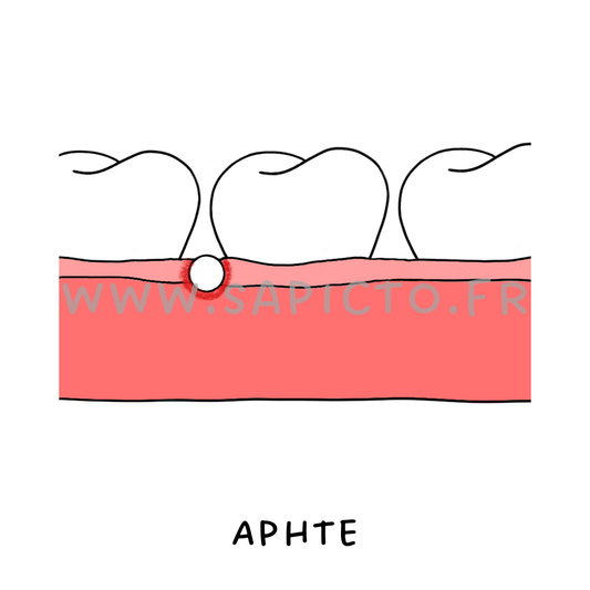 Aphte