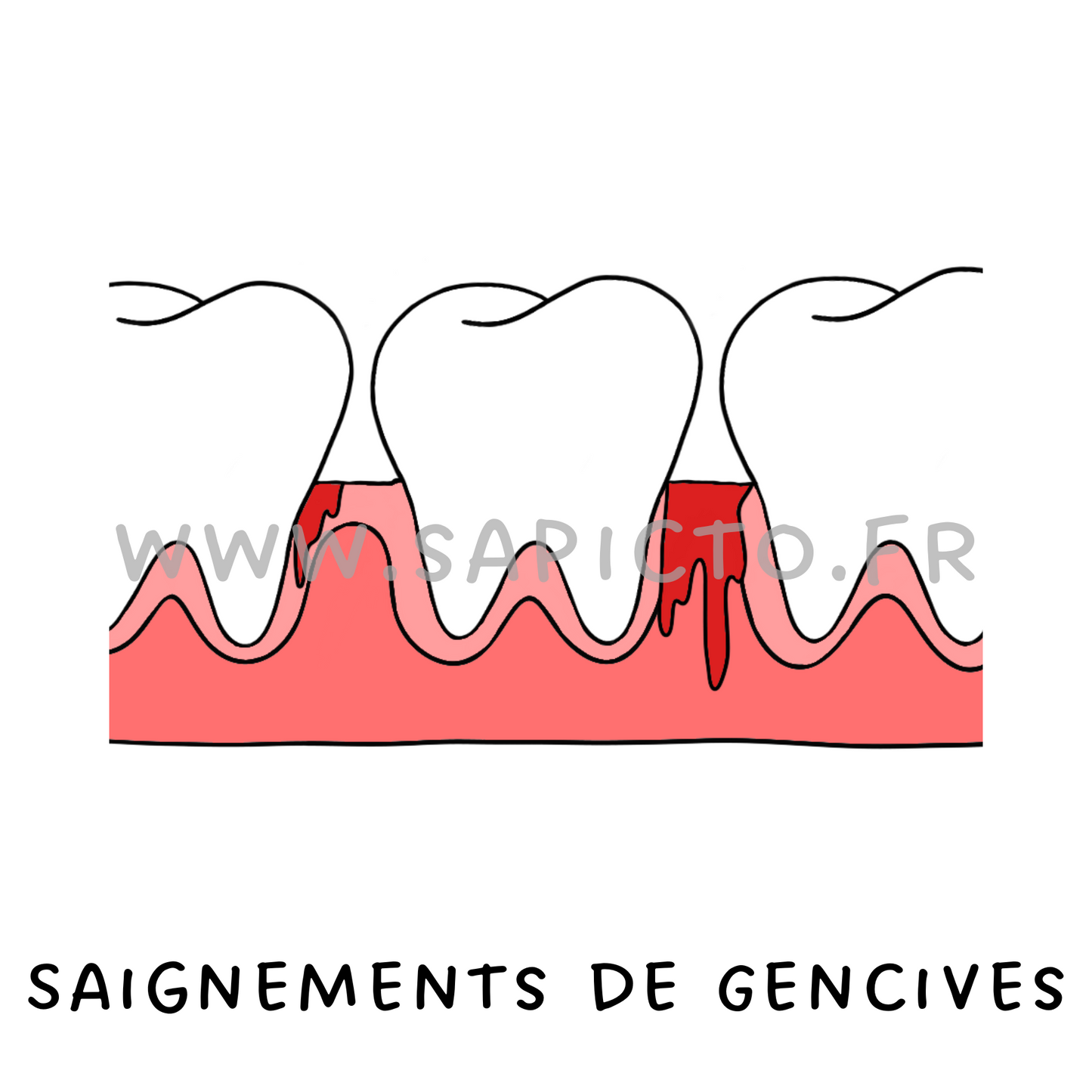 Saignements de gencives